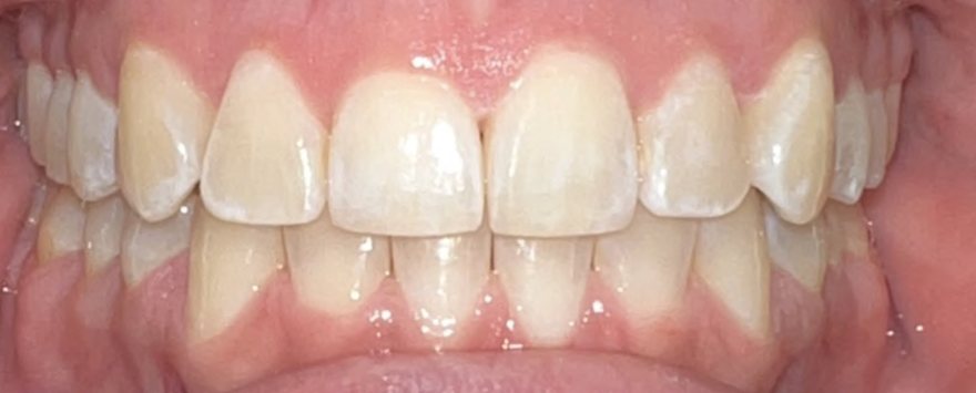 After orthodontic treatment, Blocked canines, at Embrace Orthodontics Halifax