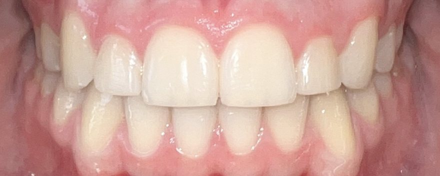 After orthodontic treatment, Blocked canines, at Embrace Orthodontics Halifax