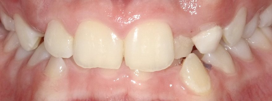Before orthodontic treatment, Blocked canines, at Embrace Orthodontics Halifax