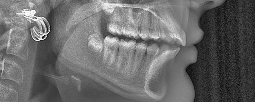 After orthodontic treatment, Protruding front teeth, at Embrace Orthodontics Halifax