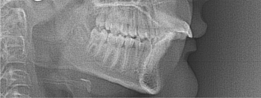 Before orthodontic treatment, Protruding front teeth, at Embrace Orthodontics Halifax