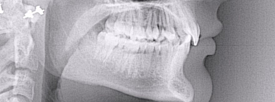 Before orthodontic treatment, Deep bite, at Embrace Orthodontics Halifax