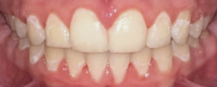 After orthodontic treatment, Gaps and spacing, at Embrace Orthodontics Halifax