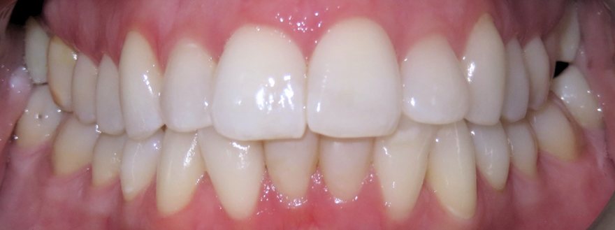Before orthodontic treatment, Deep overbite, at Embrace Orthodontics Halifax