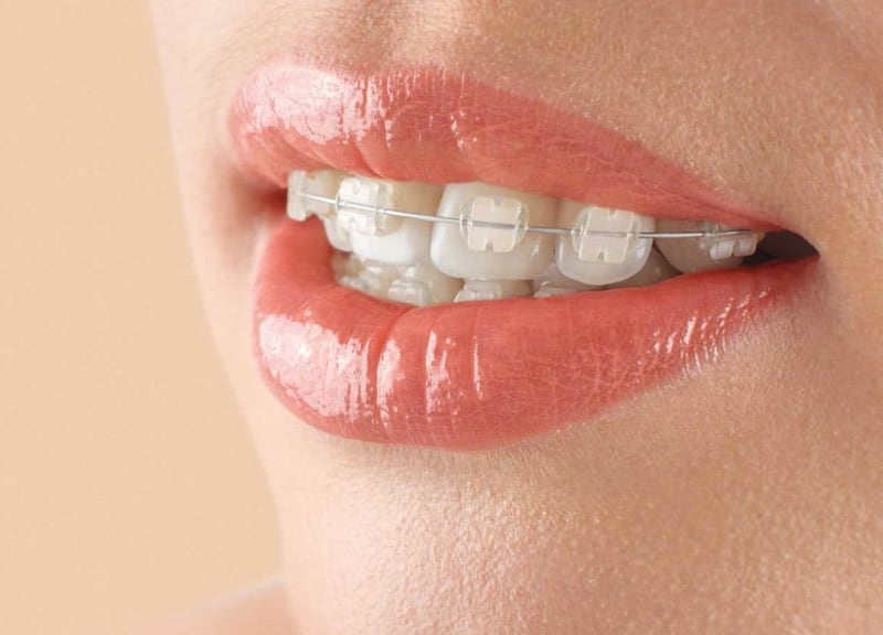 A close-up smile with discreet fixed braces