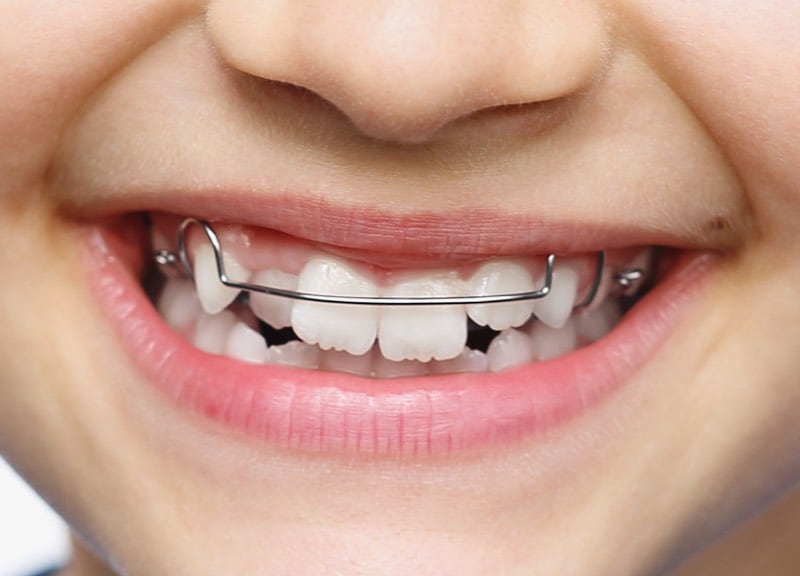 A child smiling with an early-treatment orthodontic appliance