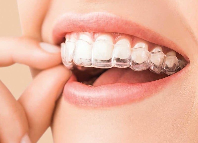 A clear Invisalign aligner being placed over the top teeth